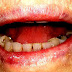 Angular cheilitis