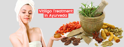 AYURVEDIC VITILIGO TREATMENT