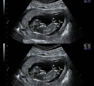 13 haftalık gebelik görüntüsü