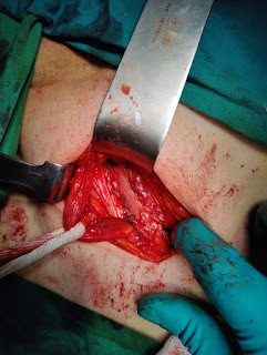 Non Mesh Hernia Surgery