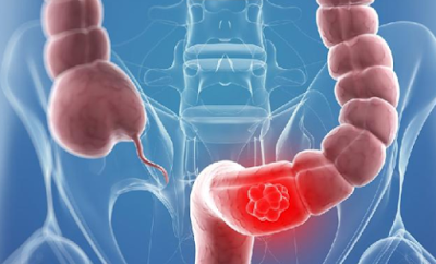 stage 4 colon cancer life expectancy.