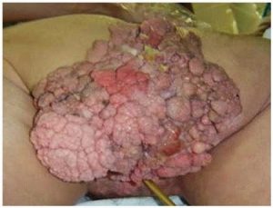 Obat Penyakit Hpv