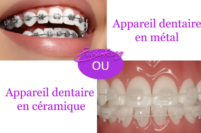 Appareils dentaires métalliques ou Appareils dentaires en céramique