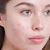 Acne Skin Care