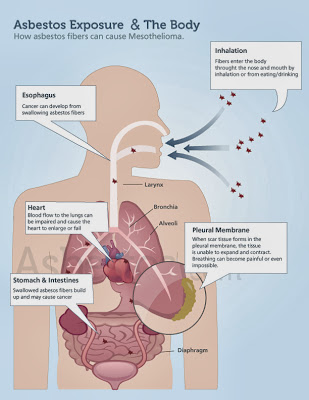 A Guide To The Relation Between Asbestos Exposure And Mesothelioma Lung Cancer