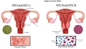 Vaccine to prevent cervical cancer