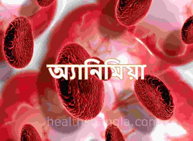 অ্যানিমিয়া - Anemia | অ্যানিমিয়ার কারণ, লক্ষণ ও প্রতিকার