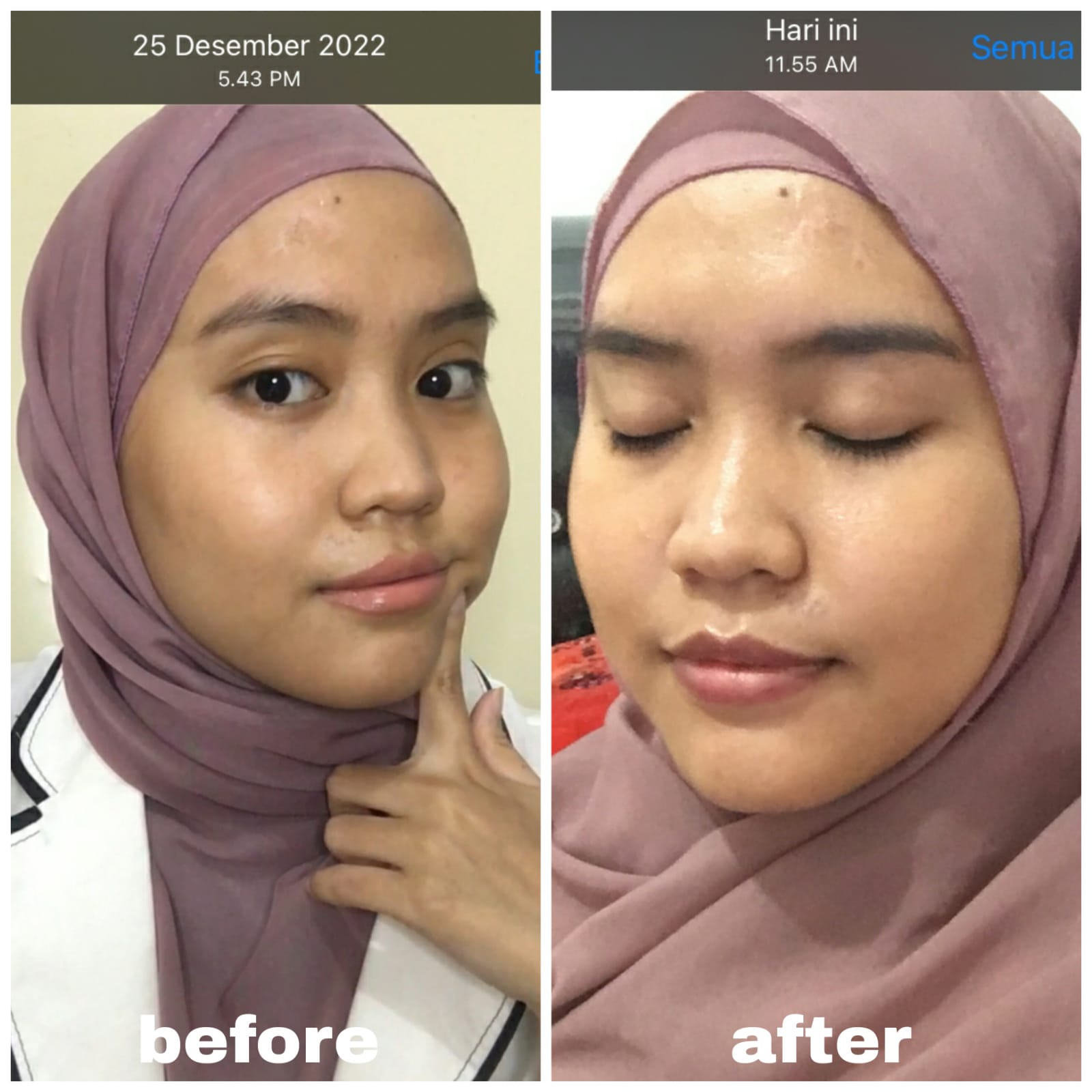 andayani rhani before after