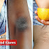 How to Lighten Dark Elbows and Knees Very Fast - Natural Home Remedies