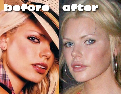 fergie plastic surgery before and after. Plastic Surgery before and