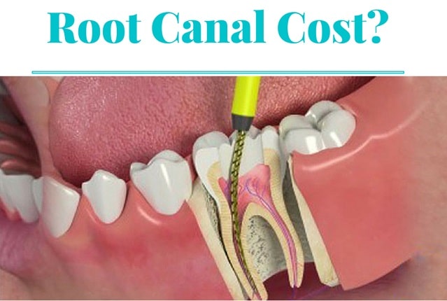 Frugal Finance: How To Pay Less For A Root Canal