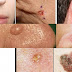 WARNING: The Earliest Signs of Cancer Appear on Your Skin  