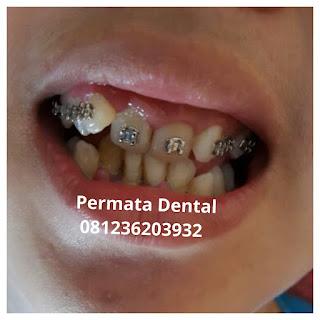 gambar foto behel bracket kawat gigi sebelum dan sesudah perawatan untuk memperbaiki merapikan gigi gingsul gigi miring renggang tonggos berantakan keluar masuk jarang diastema maju mundur tidak rapi tidak beraturan bali denpasar banyuwangi jember tidak rata kocar kacir