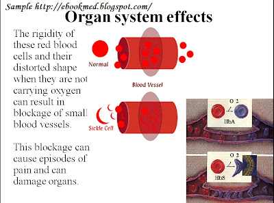 Sickle Cell Anemia Powerpoint Presentation Free Download