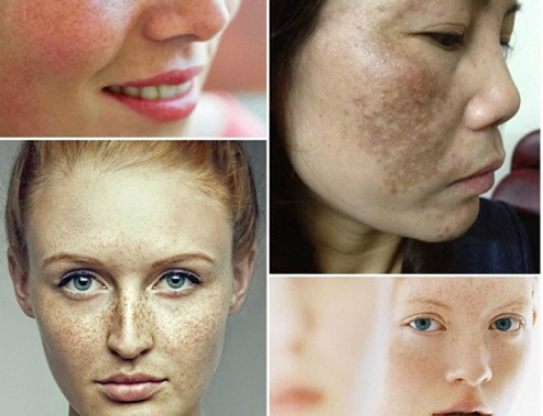 Cách trị nám da mặt lâu năm hiệu quả ít người biết