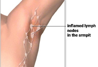 inflamed lymph nodes in the armpit التهاب الغُدَد اللمفاويّة تحت الإبط