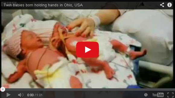 http://lankanbestvideos.blogspot.com/2014/05/us-twin-baby-sisters-born-holding-hands.html