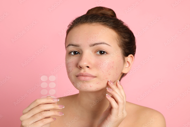 Pimple Patches : Side Effects of Using Pimple Patches on Face