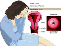 Mengobati Kanker Serviks Parah Secara Alami