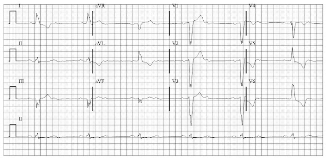 ECG of second degree block type II (2:1 AV block) with LBBB