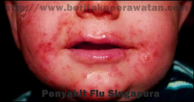 Penyakit Terbaru Flu Singapura