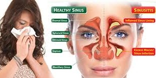 Pengobatan Penyakit Sinusitis Paling Mujarab