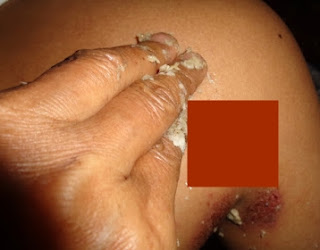 Dampa dengan Obat Herbal Alami Tradisional semoga Cepat Kering dan Sembuh Total  Bagaimana Cara Mengobati Penyakit Herpes atau Dompo secara Alami dengan Obat Herbal Tradisional Paling Ampuh semoga Cepat Kempes, Kering, dan Sembuh Total ?; Ini Dia Rahasia Dibalik Mitos Semburan Janda sanggup Bujang yang Dipercaya Ampuh Menyembuhkan Penyakit Dompo/Herpes  