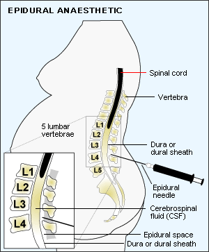 Kisah.klassik.untuk.masa.depan: Spinal vs Epidural