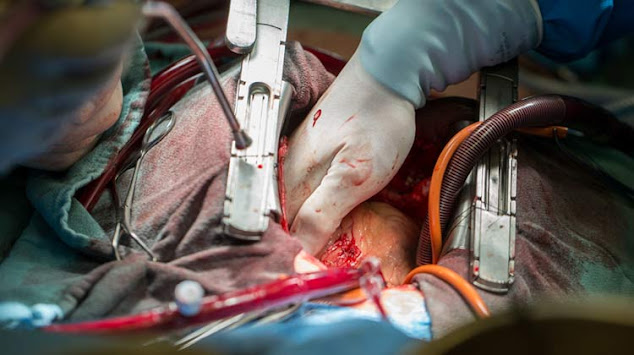 Open Heart Surgery