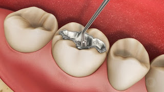 Trám răng có bền không?