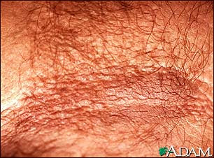 Acanthosis Nigricans Causes Symptoms Treatment