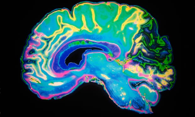 Distúrbios cerebrais graves em pessoas com sintomas leves de COVID-19
