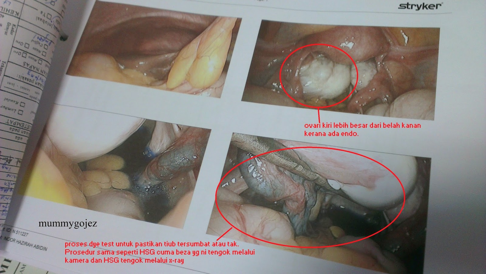 I am a mother of TWO: Pengalaman Pembedahan Laparoscopy