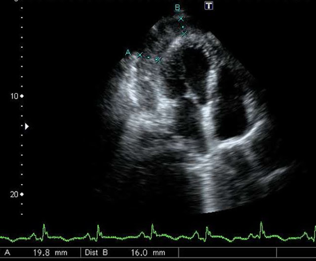 Figure 2: Lateral wall rupture concealed by a thrombus