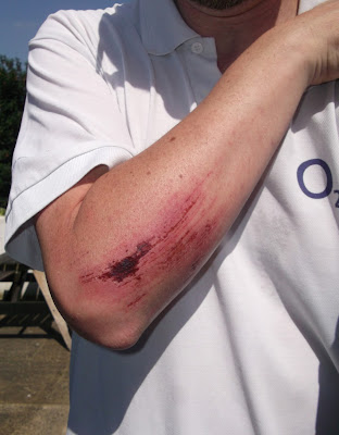 Picture of a grazed forearm after crashing on Dendix matting