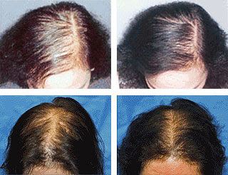 women hair transplant in Islamabad