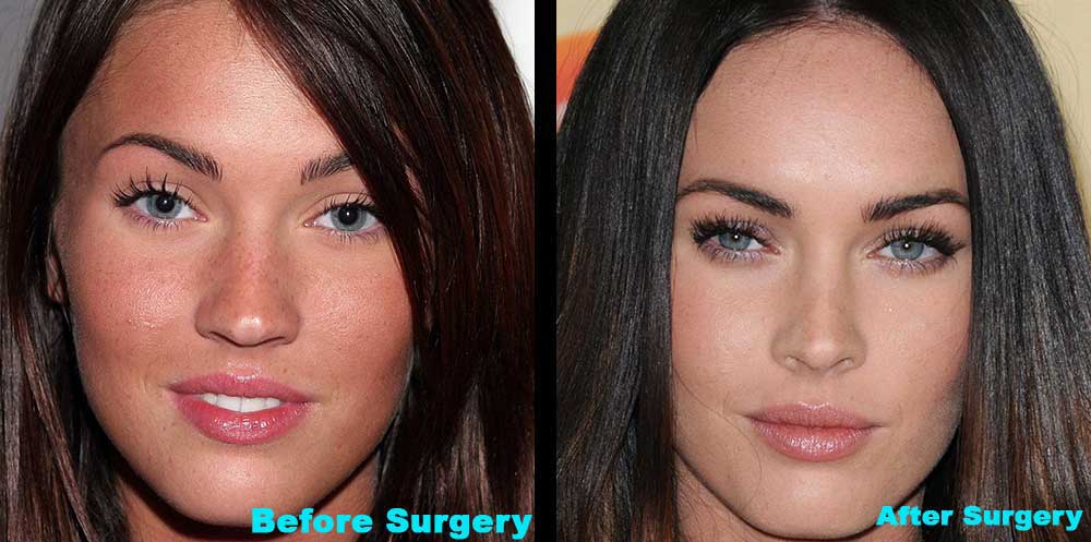 Nicki Minaj Before And After Surgery. Before: After: Megan Fox