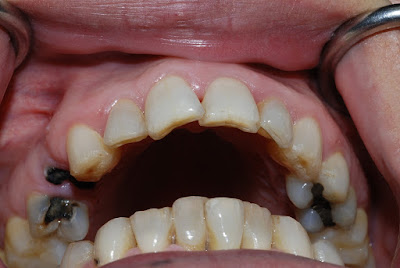 Vì sao phải thăm khám kỹ lưỡng khi nhổ răng hàm trên bị sâu?-1