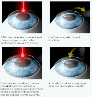 miopia graus, causas da miopia, grau miopia maximo, grau miopia positivo ou negativo, quem tem miopia deve usar oculos o tempo todo, miopia tem cura, miopia e astigmatismo, miopia 8 graus, miopia e astigmatismo juntos