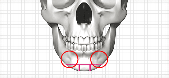 짱이뻐! - Korean Face Contouring - Front Chin Surgery