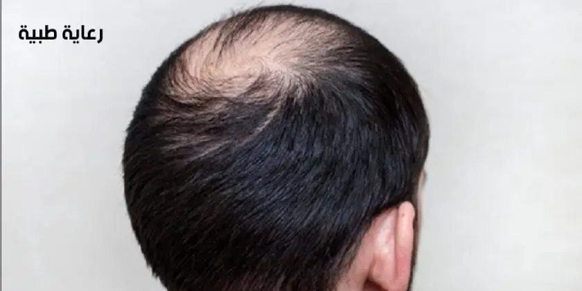 افضل علاج لتساقط الشعر الوراثي
