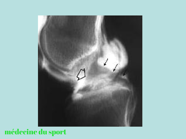 IMAGERIE DU GENOU APPLIQUÉE A LA PATHOLOGIE SPORTIVE