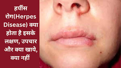 हर्पीस(Herpes) बीमारी के लक्षण, जोखिम, इलाज और क्या खाये, क्या नहीं