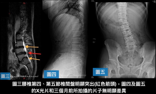 脊椎側彎檢查, 椎間盤突出, 脊椎側彎治療