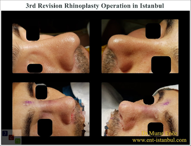 3rd Revision Nose Job in Men Istanbul, Tertirary revision rhinoplasty in Turkey, Third revision nose aesthetic surgery with rib cartilage