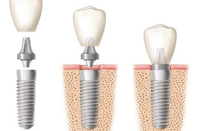 Cấy ghép răng implant như thế nào?
