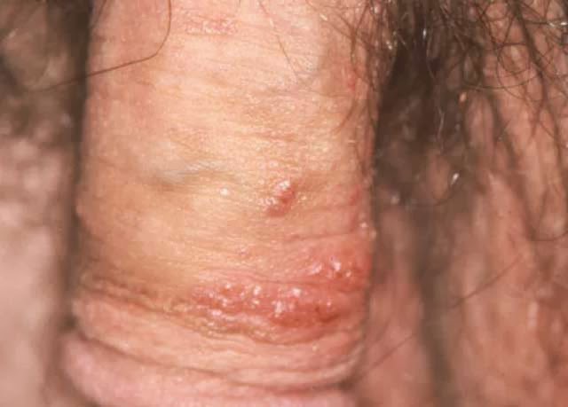 cara menghilangkan herpes