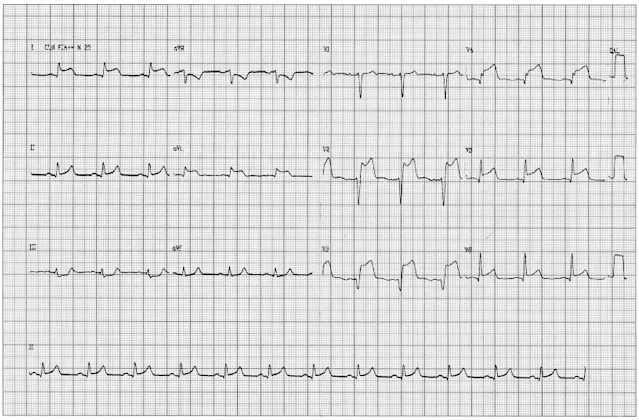 Exame físico da admissão: PA = 100 x 60 mmHg, FC = 70 bpm, FR = 18 irpm, Sat = 92%. Ritmo cardíaco regular em 2 tempos sem sopros, murmúrio vesicular presente e simétrico com estertores crepitantes em base, abdome globoso, fígado há 4 cm do rebordo costal direito, baço não percutível. Extremidades: pulsos periféricos diminuído, edema 3+/4+. ECG abaixo: