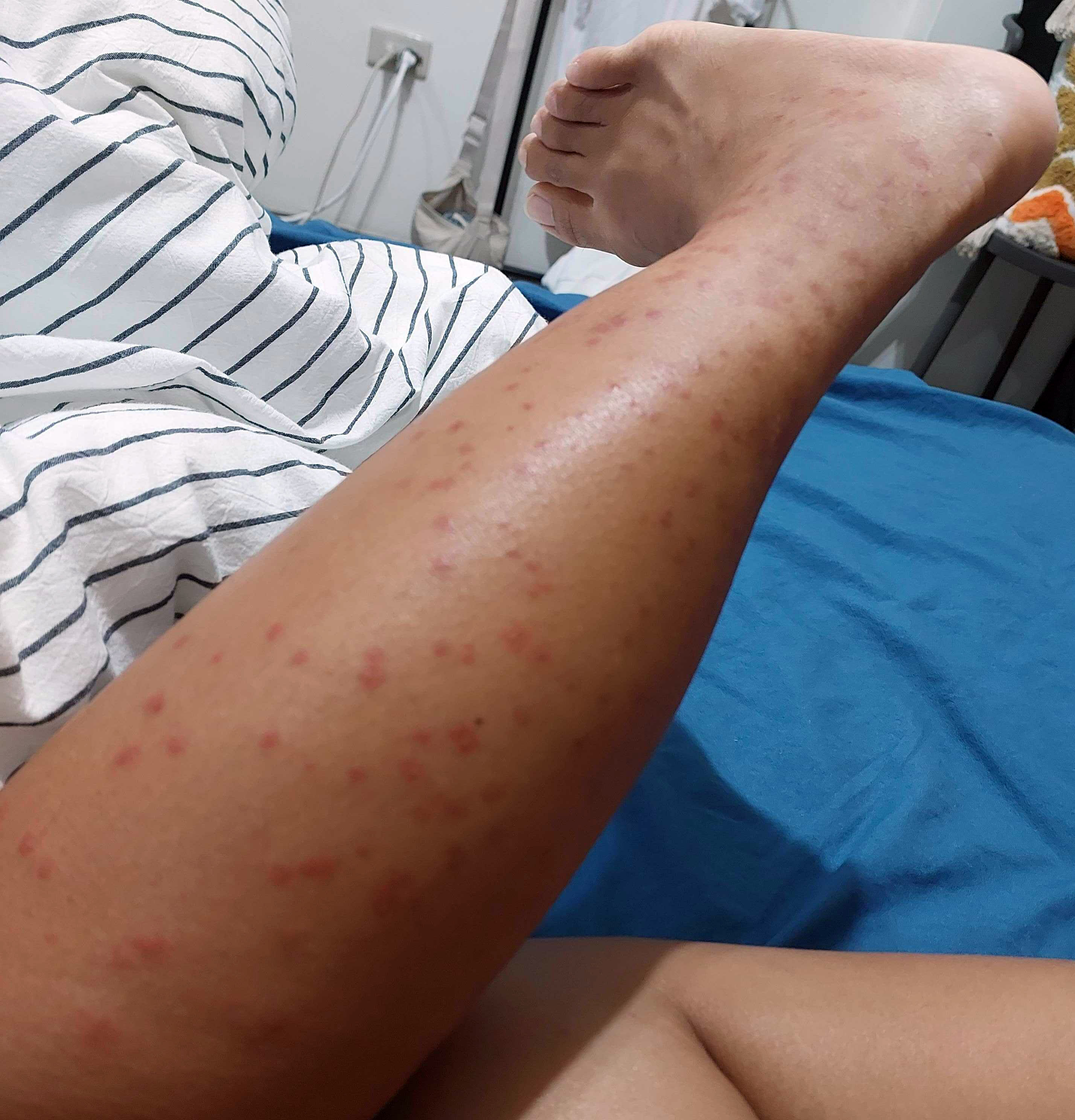 Taiwan Travel Tip: Protect Yourself from Biting Midges or Little Black  Mosquitoes