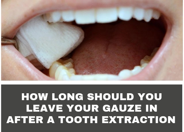 How Long Should You Leave Your Gauze in After a Tooth Extraction 